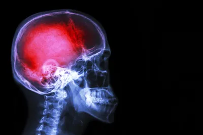 Beyin Ağrı Hissedemez