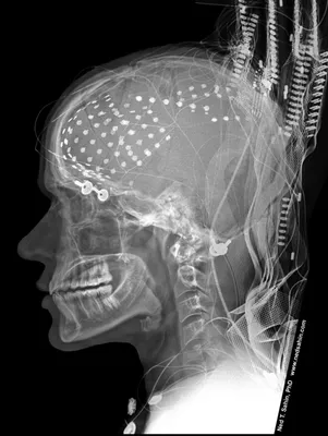 Interfaces Cérebro-Computador